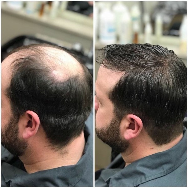 Non Surgical Hair Replacement Centre in Hyderabad