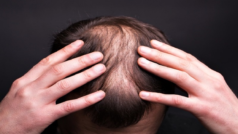 Non-Surgical Hair Restoration Service in Hyderabad